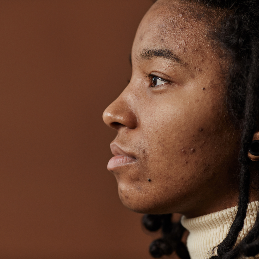 View of Acne Prone Skin: Understanding and Preventing Breakouts – 103 Collection