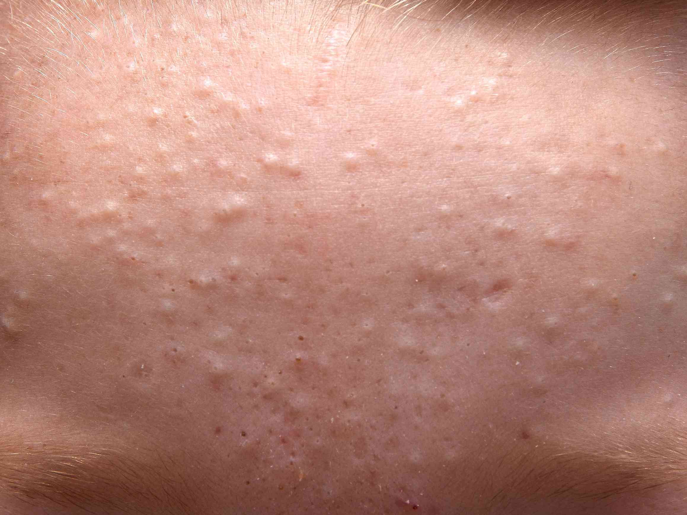 10 Tips For Nurturing Acne-Prone Skin