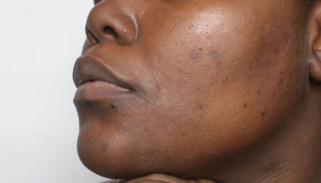 Decoding Hyperpigmentation: Causes, Treatments and Prevention