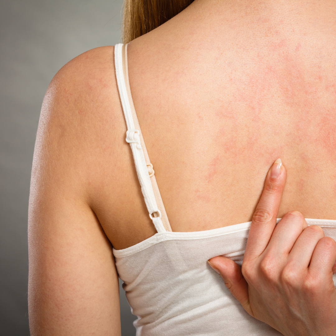 How To Prevent Eczema Flare-Ups