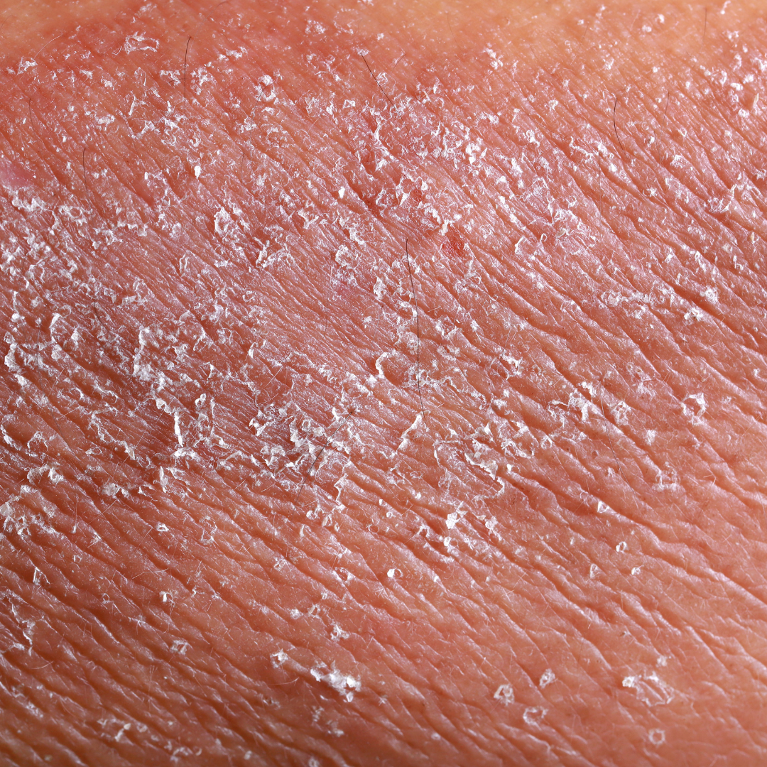 Understanding and Preventing Dry Skin: A Comprehensive Guide
